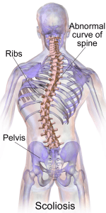 Scoliosis may be preventable